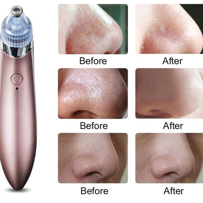 GlowSkin™ Portable Blackhead Remover – Vacuum Suction Device